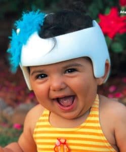 Bebé tiene que usar un casco por plagiocefalia y su familia decide hacer lo  mismo