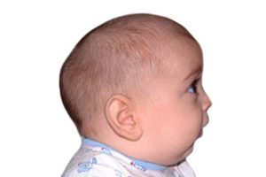 Craniostenose Malformation Congenitale Types De Craniostenose