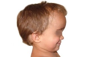 Craniosynostosis Congenital Malformation Variations In Craniosynostosis